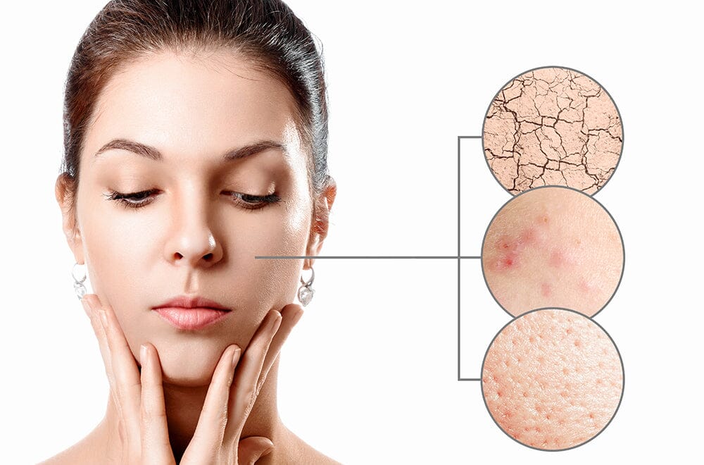 Das richtige Peeling für trockene Haut oder Mitesser