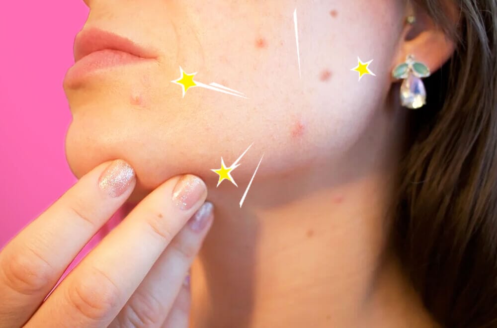 Aknenarben – Wie werde ich sie los?