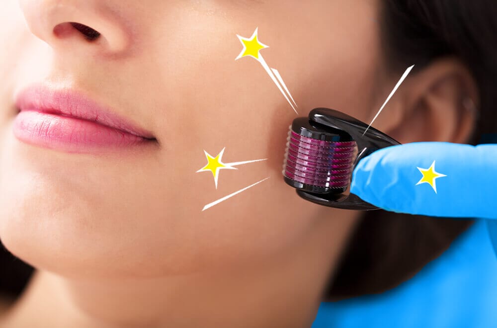 Microneedling: Fluch oder Segen?