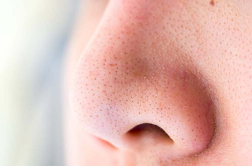 Wie du Mitesser oder Follikel-Filamente los wirst